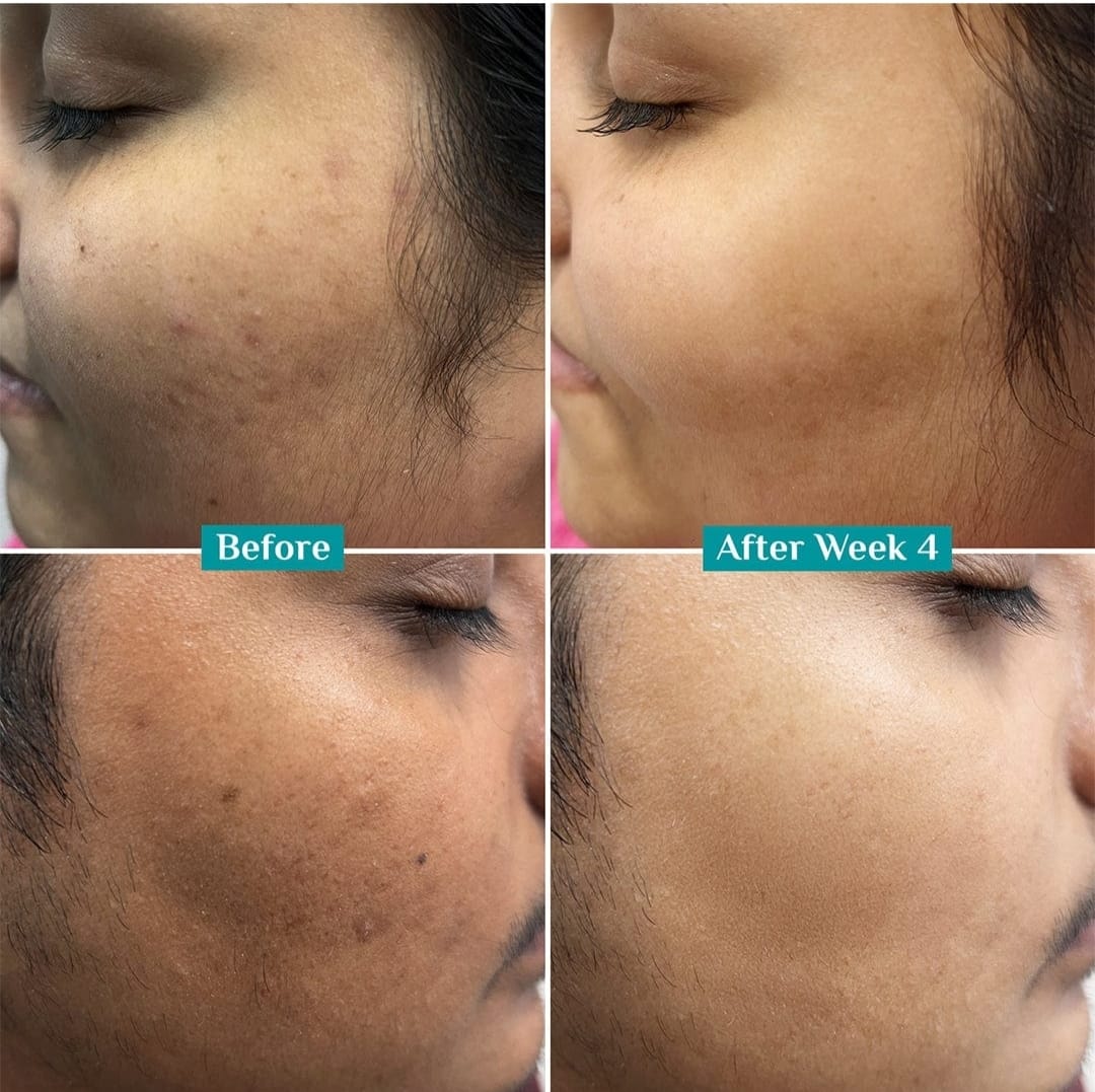 pilgrim -25% AHA, 2% BHA, 5% PHA Peeling Solution